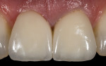 Figure 19 The definitive porcelain crowns with
optimal gingival profile complete
the illusion of natural teeth.