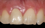 Figure 5 The clinical appearance of the definitive
crown after 1 year in situ showed that the soft-tissue profile was stable and symmetric with the left central incisor (natural tooth).