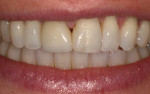 Figure 10 Papillary deficiency between maxillary central incisor teeth and the mesio-distal dimensions were apparent during normal smile.