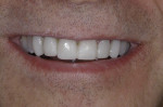 Smile view of provisional restorations.