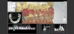 3Shape Implant Studio software combining CBCT and intraoral scan to plan surgical implant placement.
