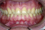 Fig 3. Incisal view of anterior teeth showing rotations and spacing at presentation.