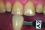 Fig 11. As the teeth being prepared are within a reasonable color range the restorations can be fabricated using a more transparent restorative material
