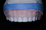 Fig 4. A wax-up of the maxillary teeth was created to illustrate a more appealing smile.