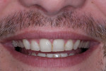 Fig 2. Preoperative close-up view of the patient’s smile.