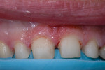 Fig 6. Adequate tooth reduction was achieved and confirmed with the reduction matrix in place in the mouth.