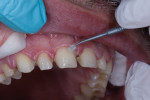 Fig 9. A universal adhesive was applied to all prepared surfaces for 20 seconds. The solvent in the adhesive was evaporated, and the teeth were then light-cured for 10 seconds each.