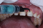 Fig 7. After the provisionals were removed, the esthetics and fit of the lithium-disilicate restorations were verified, after which the preparations were cleaned with chlorhexidine and rinsed.