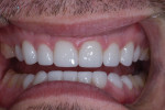 Fig 15. Postoperative retracted view of the patient’s lithium-disilicate restorations.