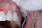 Fig 13. After light-curing from the buccal and lingual aspects for 30 seconds each per tooth, any remaining excess cement was easily cleaned off.