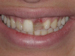 Fig. 1 Inconsistent shades and shapes of teeth and soft tissues surrounding the missing tooth contributed to an unharmonious smile for this patient.