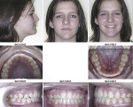 Fig 1. Initial 2D facial and intraoral photographs in CO position.