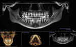 Fig 4. Reconstructed panoramic x-ray from CBCT scan. The 3D DICOM data were positioned with the midsagittal plane defined by midline structures and perpendicular to the Frankfort plane. The focal trough was set to include the TMJs in CO and the dentoalveolar trough with accurate positions of the teeth and roots. Note the difference in the vertical positioning of the TMJ complex and auditory canals from right to left. The white line is horizontal and perpendicular to the midsagittal plane and is located at the top of the left glenoid fossa.