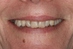 Fig 7. Pretreatment close-up smile.