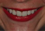 Fig 6. Post-treatment smile showing a harmonious esthetic result.