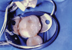 (4.) Preoperative photograph of a maxillary primary second molar.