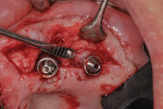 (7.) Removal of residual granulation tissue.