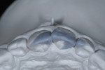 (4.) Occlusal view of the waxup.