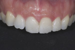 (9.) Frontal intraoral view of the final composite restorations after 12 weeks showing no postoperative clinical complications.