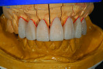 Fig 2. Wax-up of full contour
crowns and veneer copings.