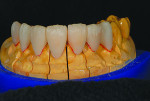 Fig 5. Crowns Nos. 5 and 12 and veneers Nos. 4 and 7-10 cut back minimally on the incisal one-third.