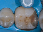 (5.) Immediate dentin sealing.