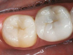 (13.) These Empress inlay and Empress onlay restorations are 17 years old. Replacing occlusal and interproximal enamel, they are bonded to stress reduced bio-bases consisting of immediate dentin sealing, resin coating, and dentin replacement.