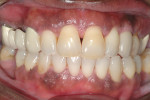 Figure 22  Completed crown on No. 11. Compare with Figure 1 as the appearance of a tooth root has been reconstructed with the help of hard tissue grafting and provisionalization with “sculpting” of the soft tissues.