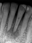 (1.) Typical radiographic example of internal root resorption.