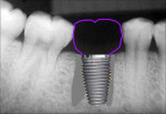 Fig 20. When the implant is centered in the space, loading on the implant is along the implant’s long axis, with no off-axis loading. Proximal areas under the contacts are minimized when a wider-diameter implant is used.