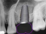 Fig 13. A 7-mm-wide implant helps create a better, more natural emergence profile approaching the missing molar and decreases potential interproximal food traps.