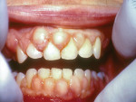 Gingival hyperplasia with increased red, edematous tissue