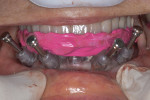 Fig 8. Full edentulous surgical guide and bite registration. Note stabilization pins.