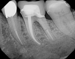 Intraoral periapical radiograph of previously treated tooth No. 19.