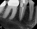 Postoperative radiograph following root canal therapy and surgical repair of the defect.