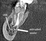 A postoperative radiograph showing extruded sealer potentially tracking the length of the mandibular canal. An immediate Postoperative CBCT scan was taken in order to ascertain the location of the sealer and its proximity to the inferior alveolar nerve. The sealer was positioned lingual to the nerve; the patient reported no symptoms at the followup
appointment.