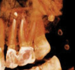 Preoperative radiograph of tooth No. 14. Root canal therapy was started by another provider. Following completion of the case, the patient had a persistant “sensation” in the region. A CBCT scan identified multiple radiopacities located in the soft tissue adjacent to the tooth. The scan was referred to an oral radiologist who identified these as potential venous calcifications known as
“phleboliths.” The patient was referred for medical evaluation.
