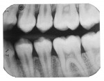 Teenager with beginning mesial and distal caries lesions of the second premolar.