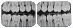 Teenager with severe Class I caries lesions
of molars and multiple proximal decalcification
and beginning caries lesions.