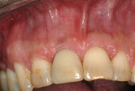 A 4-month postoperative image shows precise implant placement according to the prosthetically-based plan. The implant is ideally positioned and the facial bone graft is visible.