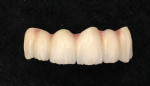 Fig 17. 1M1 dentin ceramic used to finish overall build-up.