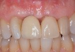 Fourteen months after surgery, the
postoperative situation is clinically healthy. A slight degree of soft tissue loss has occurred
proximally from tooth No. 7 through No. 9.
The site is free of inflammation.