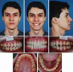 Fig 1. Pretreatment facial and intraoral photographs.