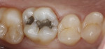 Mesial marginal crack on tooth No. 3.