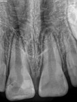 An 8-year-old female patient presented with a history of a traumatic fracture to tooth No. 8, which was repaired 3 weeks prior, and a clinical and radiographic exam consistent with pulpal necrosis with symptomatic apical periodontitis in a partially erupted immature tooth.