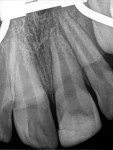A 9-year-old female patient presented with a history of traumatic fracture to tooth No. 9, which was repaired 1 year prior to presentation, and a clinical and  radiographic exam consistent with pulpal necrosis with acute apical abscess.