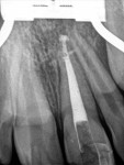 Gutta percha was used to obturate the coronal portion of the prepared canal space.