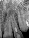 Complete apical closure as well as apical healing was noted at 1-year follow-up appointment.