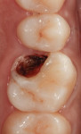 Peroperative view of tooth No. 14.