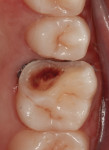 Tooth No. 14 following preparation for an MOBL onlay.